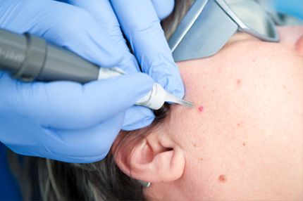 A close-up view of a skin treatment procedure. A healthcare professional, wearing blue gloves, uses a device on a small blemish on a patient's skin. The patient is wearing protective eyewear, and the focus is on the treatment process targeting the blemish.