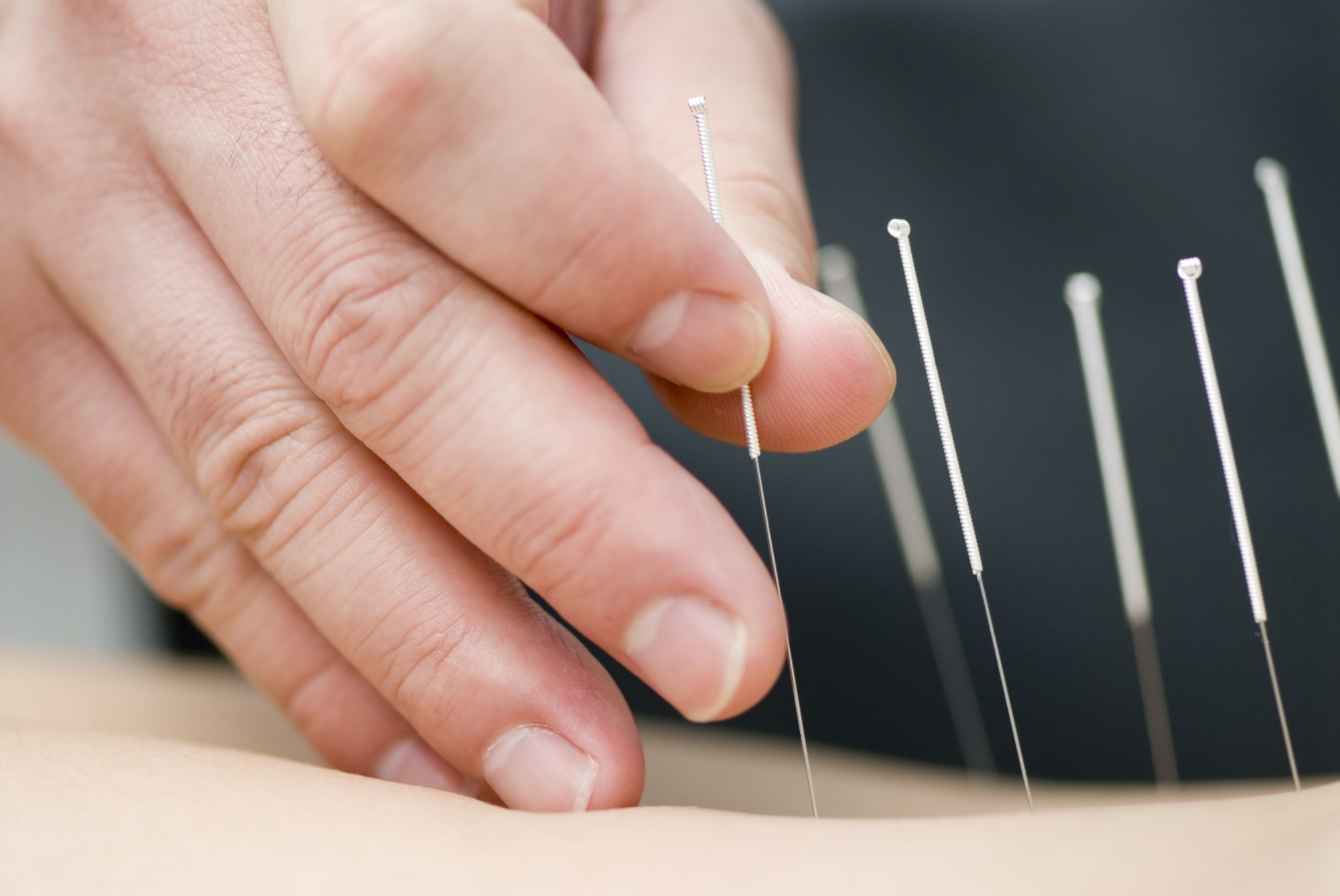 A close-up of a hand inserting an acupuncture needle into a person's skin. Several other needles are already placed in the skin nearby, illustrating an acupuncture treatment session aimed at promoting healing and well-being.